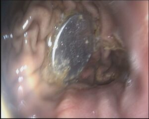 Endoscopic view of battery inside stomach,Dr. Masfique A Bhuiyan FCPS