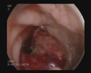 Rectal cancer,Dr. Masfique A Bhuiyan FCPS