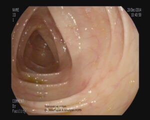 transverse colon, Dr. Masfique A Bhuiyan FCPS