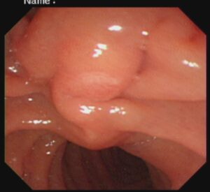 #ercp​ #ইআরসিপি​ ERCP METALIC STENTING,DR. Masfique A Bhuiyan FCPS