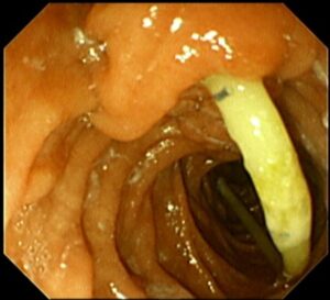 ই আর সি পি (ERCP) এর মাধ্যমে পিত্তনালী এর স্ট্যান্ট অপসারণ। Dr.Masfique Ahmed Bhuiyan FCPS