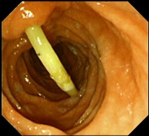 ই আর সি পি (ERCP) এর মাধ্যমে পিত্তনালী এর স্ট্যান্ট অপসারণ। Dr.Masfique Ahmed Bhuiyan FCPS