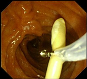 ই আর সি পি (ERCP) এর মাধ্যমে পিত্তনালী এর স্ট্যান্ট অপসারণ। Dr.Masfique Ahmed Bhuiyan FCPS