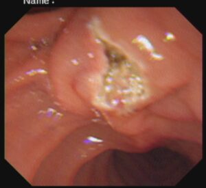 #ercp​ #ইআরসিপি​ ERCP METALLIC STENTING,DR. Masfique A Bhuiyan FCPS