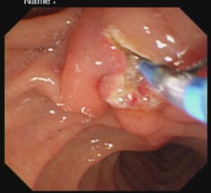 #ercp​ #ইআরসিপি​ ERCP METALLIC STENTING,DR. Masfique A Bhuiyan FCPS