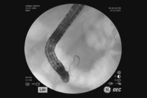 #ercp​ #ইআরসিপি​ ERCP METALLIC STENTING,DR. Masfique A Bhuiyan FCPS