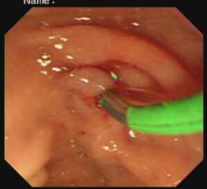 #ercp​ #ইআরসিপি​ ERCP stone extraction,DR. Masfique A Bhuiyan FCPS