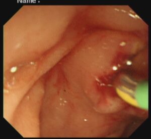 #ercp​ #ইআরসিপি​ ERCP stone extraction,DR. Masfique A Bhuiyan FCPS