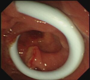 periampullary diverticula ERCP,Dr. Masfique A Bhuiyan FCPS