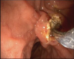 ERCP Metallic stenting,dr. masfique a bhuiyan FCPS