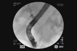 #ercp​ #ইআরসিপি​ ERCP METALLIC STENTING,DR. Masfique A Bhuiyan FCPS