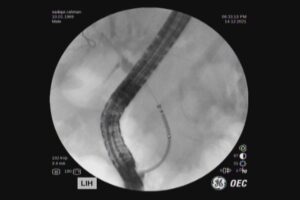 #ercp​ #ইআরসিপি​ ERCP METALLIC STENTING,DR. Masfique A Bhuiyan FCPS