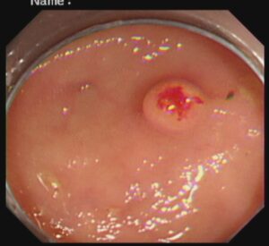 পলিপ সার্জারি ENDOSCOPIC MUCOSAL RESECTOIN(EMR) Dr. Masfique A Bhuiyan FCPS