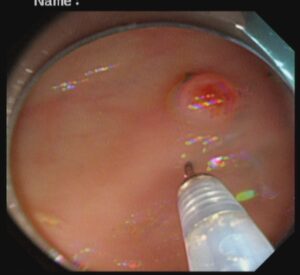 পলিপ সার্জারি ENDOSCOPIC MUCOSAL RESECTOIN(EMR) Dr. Masfique A Bhuiyan FCPS