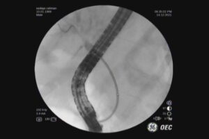 #ercp​ #ইআরসিপি​ ERCP METALLIC STENTING,DR. Masfique A Bhuiyan FCPS