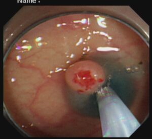 পলিপ সার্জারি ENDOSCOPIC MUCOSAL RESECTOIN(EMR) Dr. Masfique A Bhuiyan FCPS