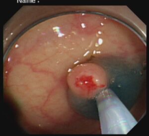 পলিপ সার্জারি ENDOSCOPIC MUCOSAL RESECTOIN(EMR) Dr. Masfique A Bhuiyan FCPS