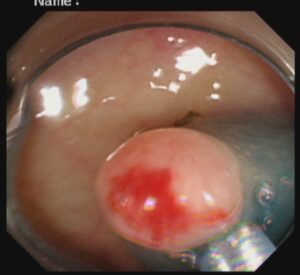 পলিপ সার্জারি ENDOSCOPIC MUCOSAL RESECTOIN(EMR) Dr. Masfique A Bhuiyan FCPS