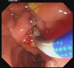 #ercp​ #ইআরসিপি​ ERCP METALLIC STENTING,DR. Masfique A Bhuiyan FCPS