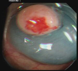 পলিপ সার্জারি ENDOSCOPIC MUCOSAL RESECTION(EMR) Dr. Masfique A Bhuiyan FCPS