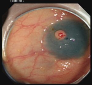 পলিপ সার্জারি ENDOSCOPIC MUCOSAL RESECTION(EMR) Dr. Masfique A Bhuiyan FCPS