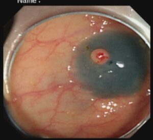 পলিপ সার্জারি ENDOSCOPIC MUCOSAL RESECTION(EMR) Dr. Masfique A Bhuiyan FCPS