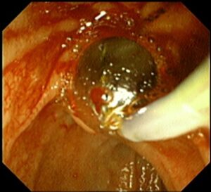 ই আর সি পি (ERCP) এর মাধ্যমে পিত্তনালী এর পাথর অপসারণ। Dr.Masfique Ahmed Bhuiyan FCPS