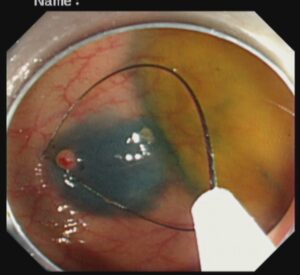 পলিপ সার্জারি ENDOSCOPIC MUCOSAL RESECTION(EMR) Dr. Masfique A Bhuiyan FCPS