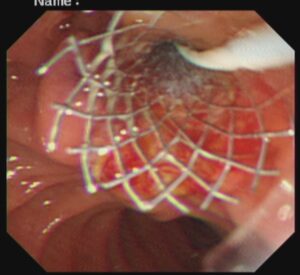 #ercp​ #ইআরসিপি​ ERCP METALLIC STENTING,DR. Masfique A Bhuiyan FCPS