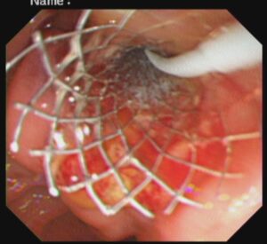 #ercp​ #ইআরসিপি​ ERCP METALLIC STENTING,DR. Masfique A Bhuiyan FCPS