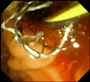 ই আর সি পি (ERCP) এর মাধ্যমে পিত্তনালী এর ক্যান্সার চিকিৎসায় স্ট্যান্টিং । Dr.Masfique Ahmed Bhuiyan FCPS