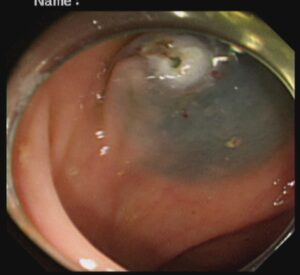 পলিপ সার্জারি ENDOSCOPIC MUCOSAL RESECTION(EMR) Dr. Masfique A Bhuiyan FCPS