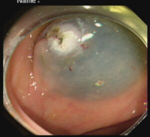 পলিপ সার্জারি ENDOSCOPIC MUCOSAL RESECTOIN(EMR) Dr. Masfique A Bhuiyan FCPS