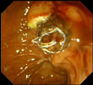 ই আর সি পি (ERCP) এর মাধ্যমে পিত্তনালী এর ক্যান্সার চিকিৎসায় স্ট্যান্টিং । Dr.Masfique Ahmed Bhuiyan FCPS