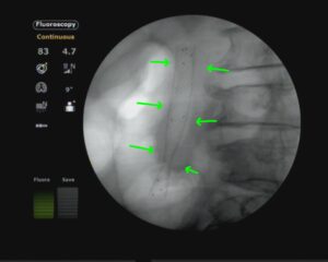 ERCP Metallic stenting,dr. masfique a bhuiyan FCPS