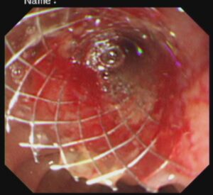 #ercp​ #ইআরসিপি​ ERCP METALLIC STENTING,DR. Masfique A Bhuiyan FCPS