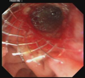 #ercp​ #ইআরসিপি​ ERCP METALLIC STENTING,DR. Masfique A Bhuiyan FCPS