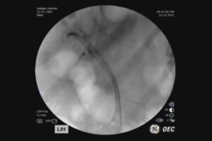 #ercp​ #ইআরসিপি​ ERCP METALLIC STENTING,DR. Masfique A Bhuiyan FCPS