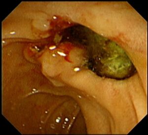 ই আর সি পি (ERCP) এর মাধ্যমে পিত্তনালী এর পাথর অপসারণ। Dr.Masfique Ahmed Bhuiyan FCPS