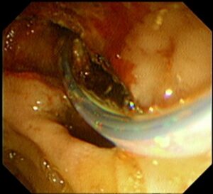 ই আর সি পি (ERCP) এর মাধ্যমে পিত্তনালী এর পাথর অপসারণ। Dr.Masfique Ahmed Bhuiyan FCPS