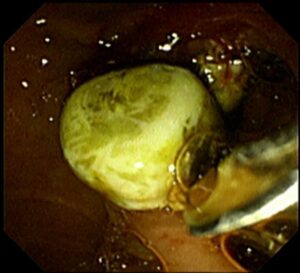 ই আর সি পি (ERCP) এর মাধ্যমে পিত্তনালী এর পাথর অপসারণ। Dr.Masfique Ahmed Bhuiyan FCPS