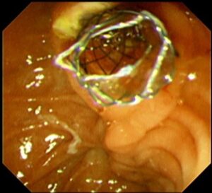 ই আর সি পি (ERCP) এর মাধ্যমে পিত্তনালী এর ক্যান্সার চিকিৎসায় স্ট্যান্টিং । Dr.Masfique Ahmed Bhuiyan FCPS