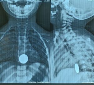 X-ray of foreign body (Coin) ingestion.