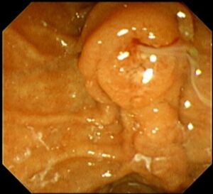 ই আর সি পি (ERCP) এর মাধ্যমে পিত্তনালী এর ক্যান্সার চিকিৎসায় স্ট্যান্টিং । Dr.Masfique Ahmed Bhuiyan FCPS

