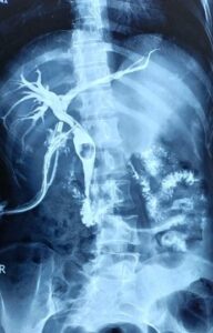 T-tube cholangiogram with a retained stone. Dr. Masfique A Bhuiyan FCPS.