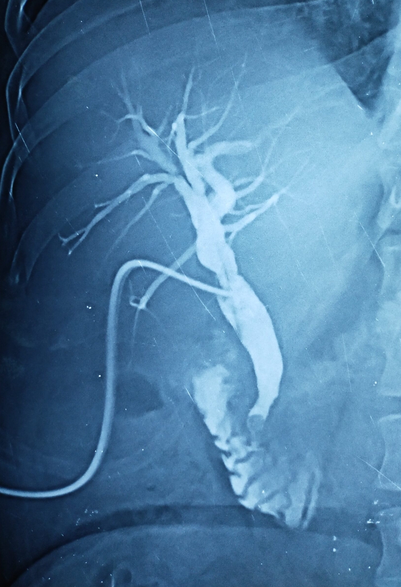 T-tube cholangiogram Dr. Masfique A Bhuiyan