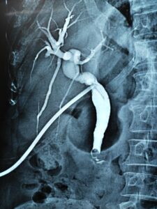 T-tube cholangiogram with retrained stone in CBD