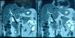 Post cholecystectomy MRCP shows retained stone in lower CBD.
Dr. Masfique A Bhuiyan FCPS