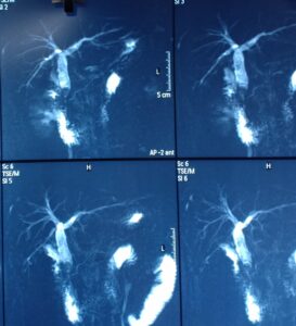 Post cholecystectomy MRCP shows retained stone in lower CBD.
Dr. Masfique A Bhuiyan FCPS