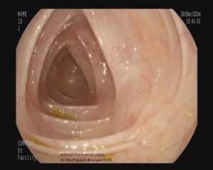 transverse colon, Dr. Masfique A Bhuiyan FCPS